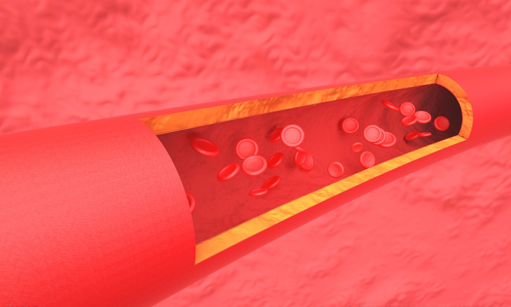 曝光一根血管堵塞的全过程