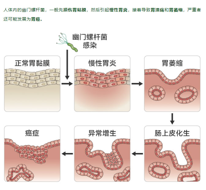 突然有口气，是得了幽门螺杆菌吗？